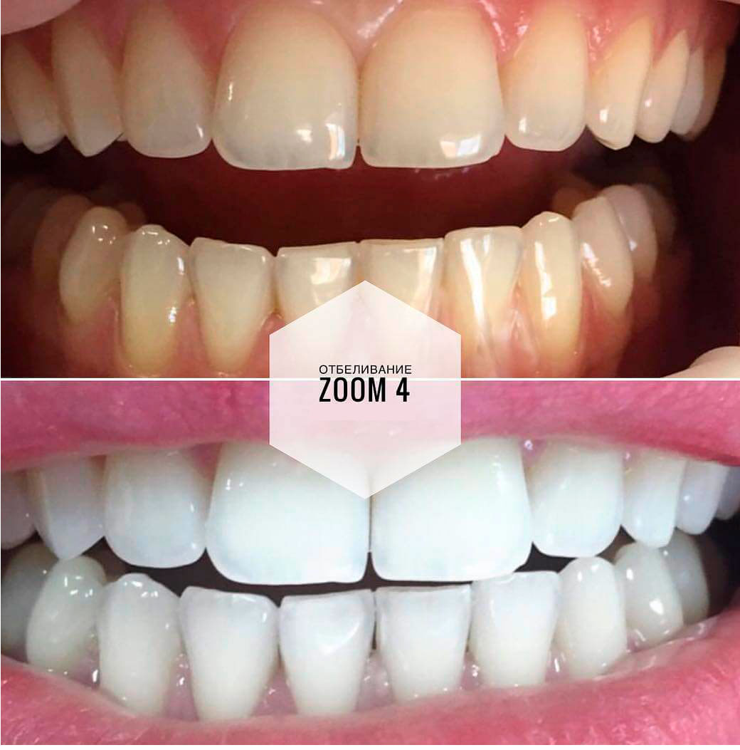 Отбеливание зубов zoom 4: особенности процедуры